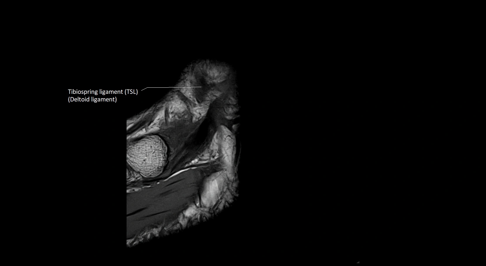 MRI ankle ligaments anatomy sagittal 3T image 1.webp